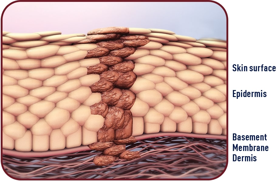 Dangers of actinic keratosis (AK) – AMELUZ® and BF-RhodoLED®
