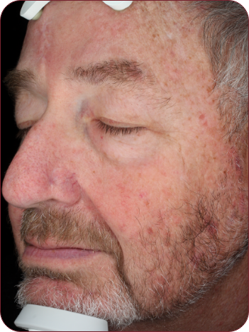 Man's face with actinic keratosis lesions photographed before photodynamic therapy treatment with ameluz.