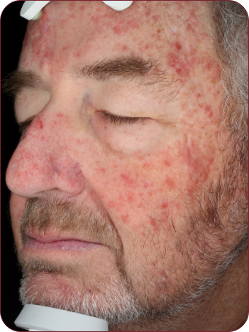 Man's face with red scabbing photographed 3 days after photodynamic therapy treatment with ameluz.