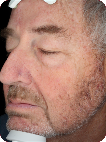 Man's healed face photographed 14 days after treatment of actinic keratosis using photodynamic therapy with ameluz.