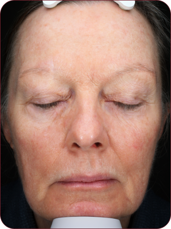 Woman's face with actinic keratosis lesions photographed before photodynamic therapy treatment with ameluz.