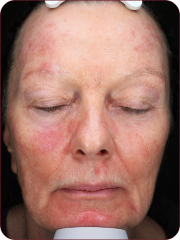 Woman's face with reddening, photographed 3 days after photodynamic therapy treatment with ameluz.