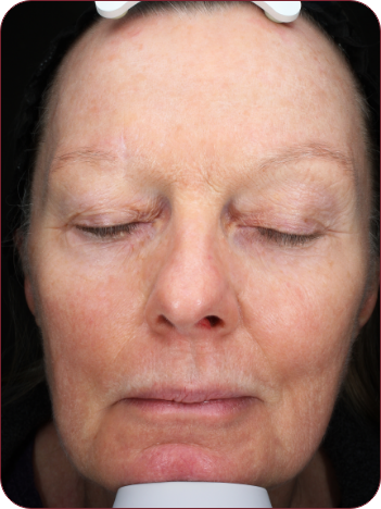 Woman's face healed face photographed 14 days after treatment of actinic keratosis using photodynamic Therapy with ameluz