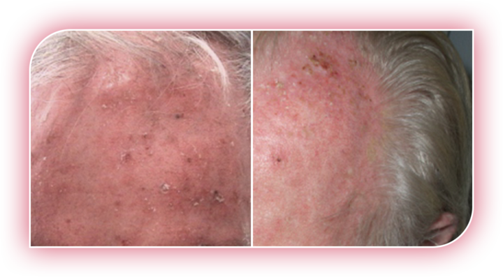 Image of AK lesions on the face and scalp of a patient.